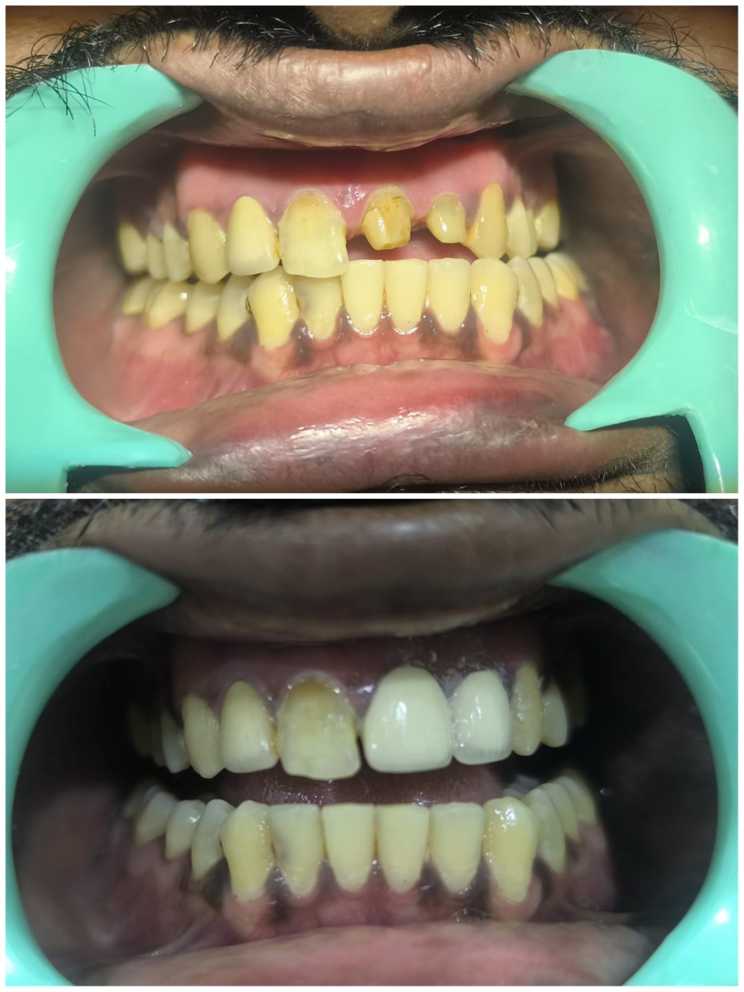 Anterior broken teeth ceramic crown reconstruction before and after