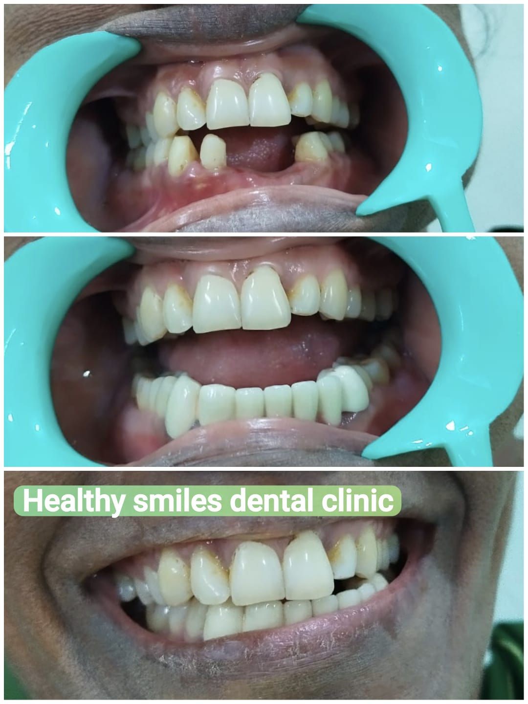 Lower arch fixed partial denture FPD smile restoration before and after