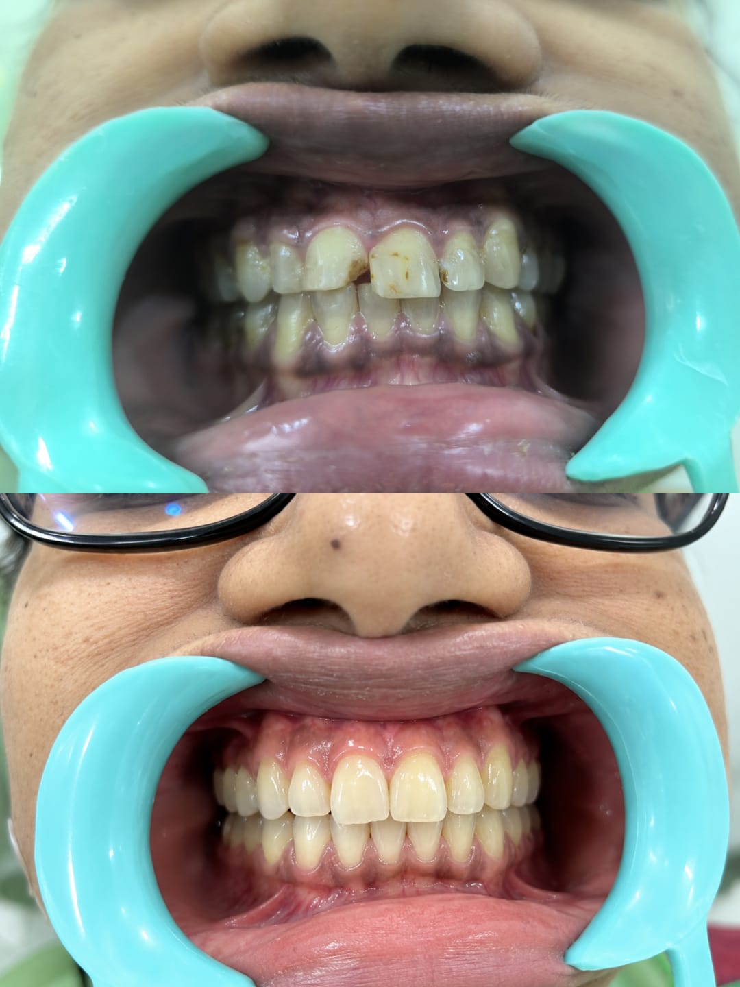 Smile correction and alignment treatment before and after