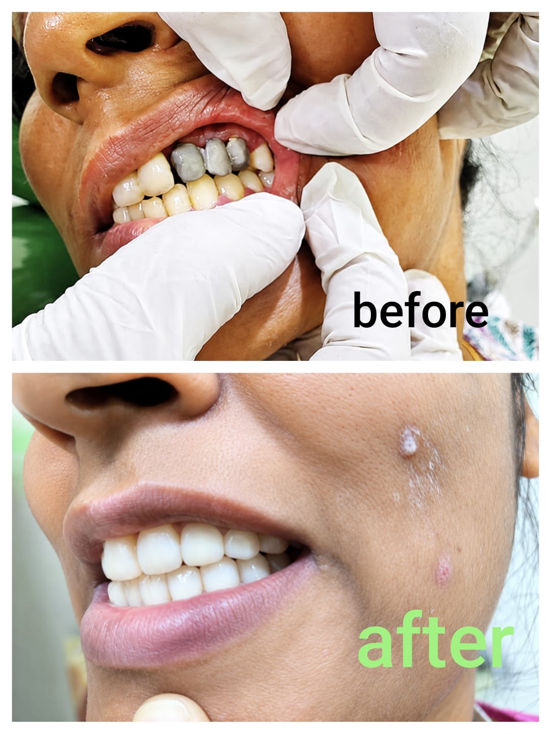 Full Arch Zirconia Crown Smile Makeover Before and After