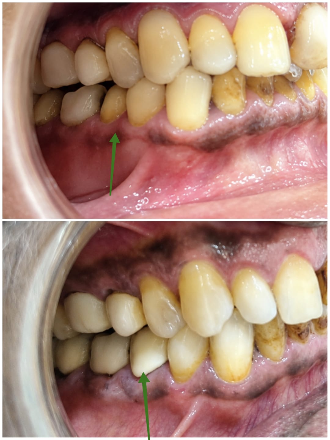Premolar porcelain cap tooth restoration before and after