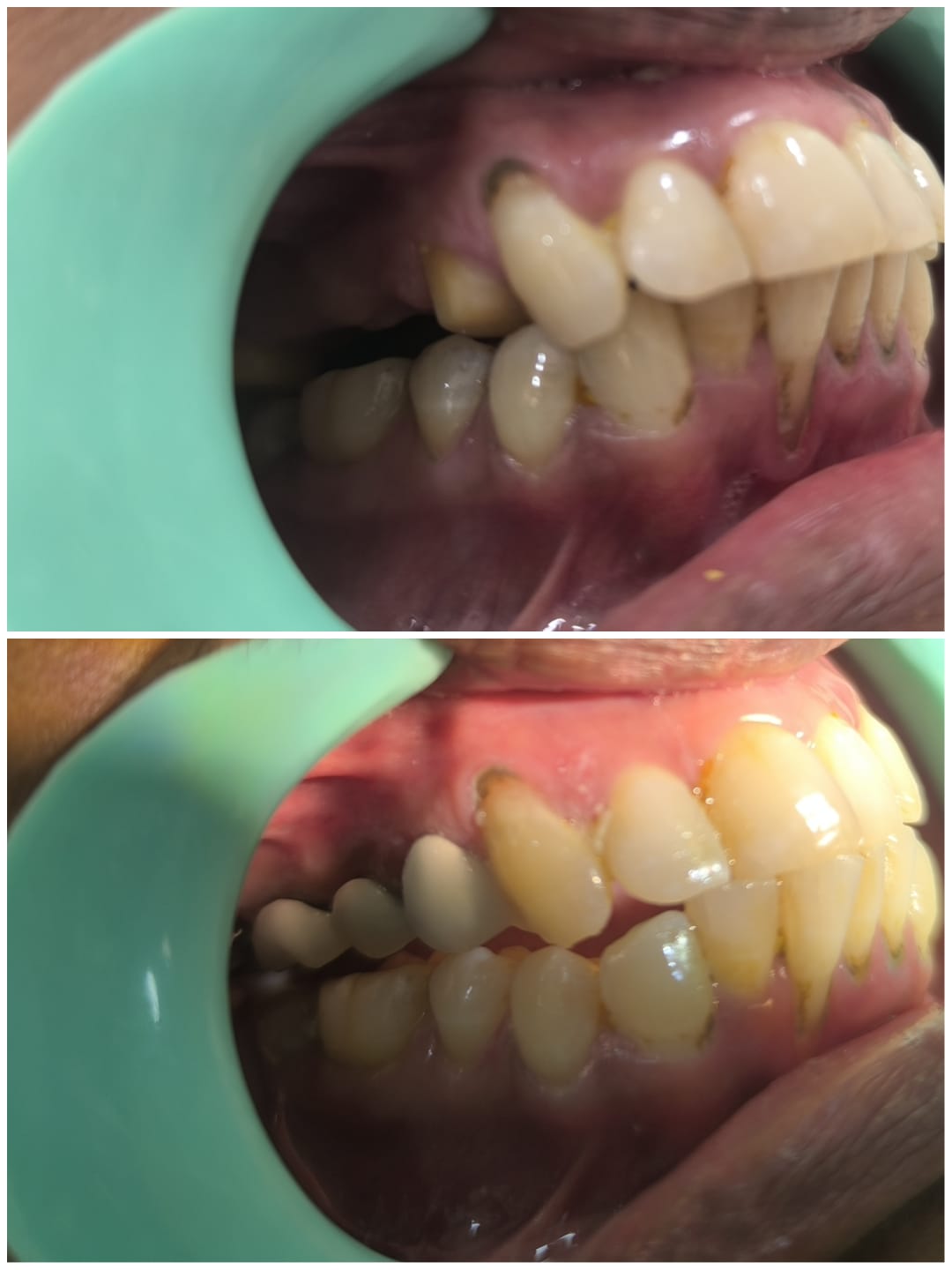 Posterior PFM porcelain-fused-to-metal dental bridge placement before and after