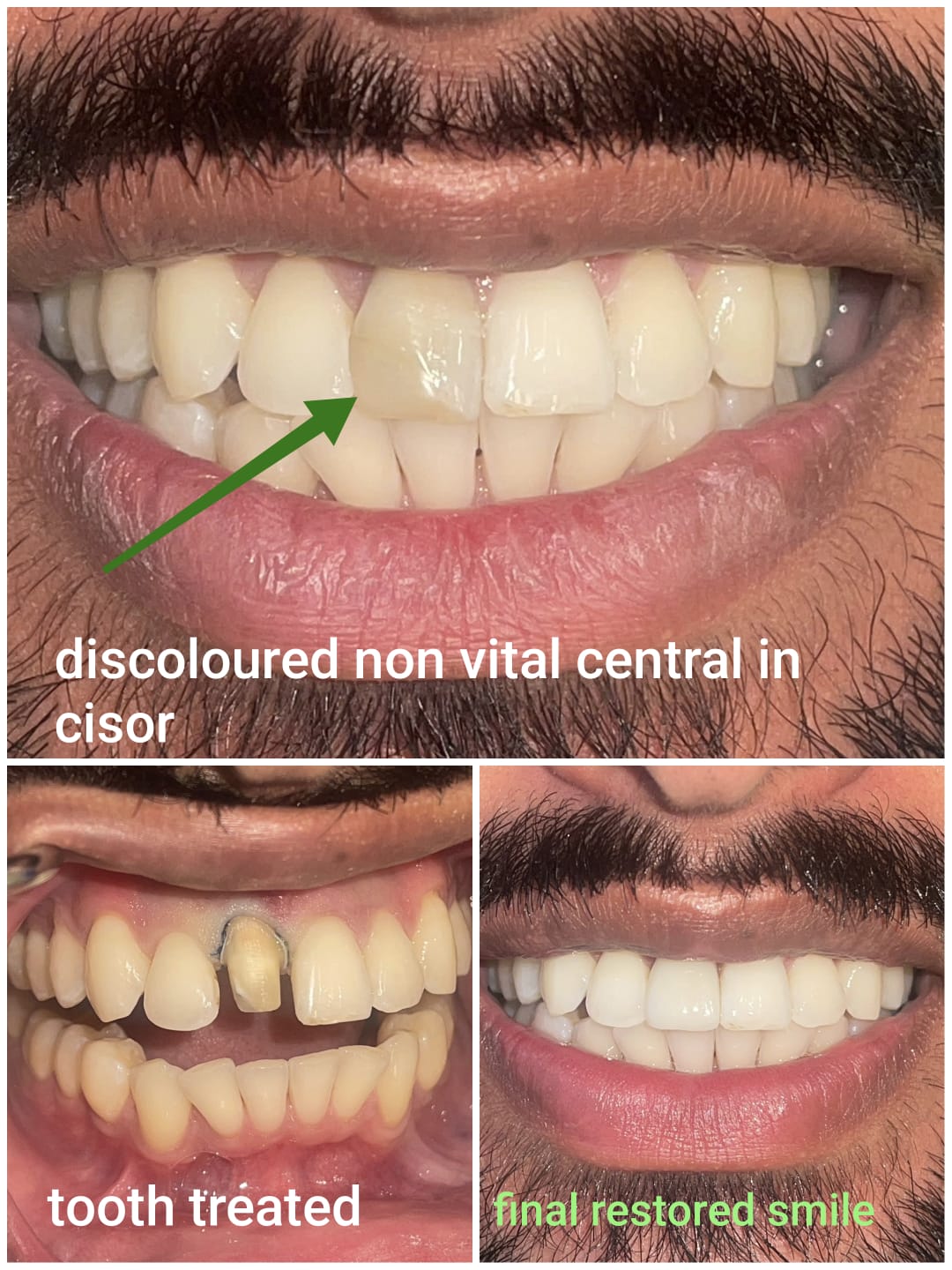 Discolored non vital central incisor root canal treatment and final restored smile